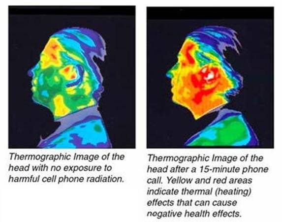 mobile phone brain damage